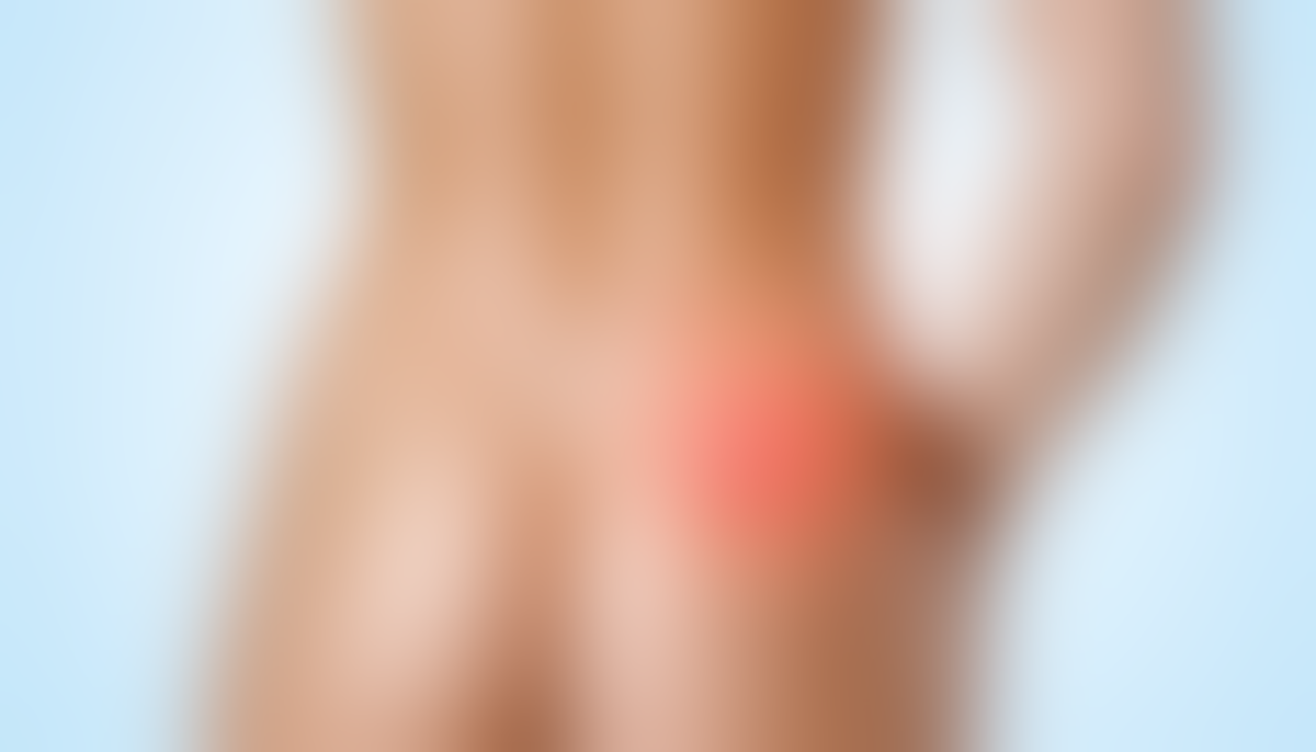 découvrez comment reconnaître les premiers symptômes du kyste pilonidal afin d'agir rapidement et éviter les complications.